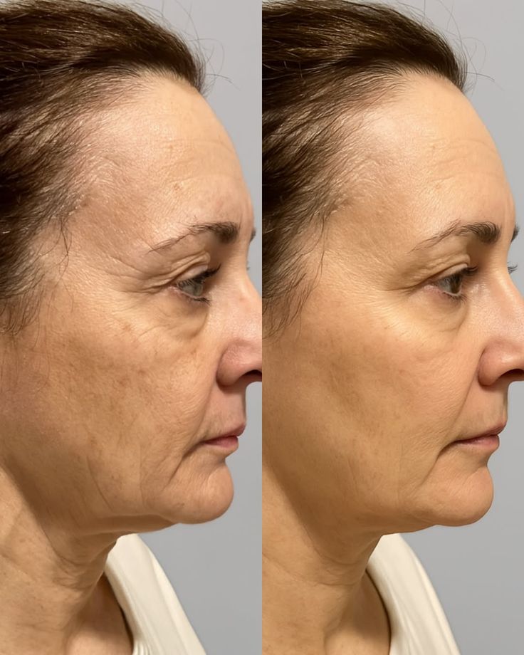 Avant / Après — Pommettes Sculptées + Lifting Global
